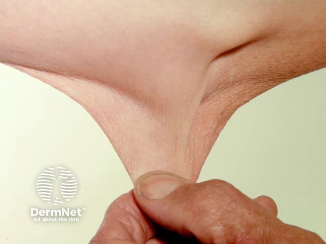 Clinical image illustrating features relevant to Ehlers-Danlos Syndrome